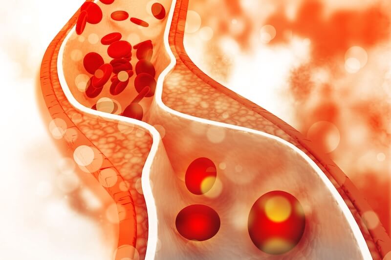 Giảm mức cholesterol của bạn